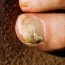 6 natural ways to defeat toenail fungus