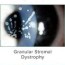 corneal dystrophies treatment