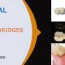 types of dental bridges smile dental