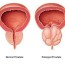 enlarged prostate bph urology