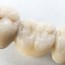dental bridge 4 types benefits use