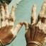 vitiligo disease causes vitiligo
