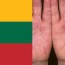skin disease in lithuania