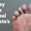 8 easy ways to heal athlete s foot