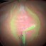 greenlight laser therapy ablation