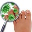 fungus that causes athlete s foot live