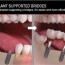 types of dental bridges what type is
