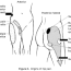 hip pain arthritis rheumatism