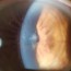 corneal dystrophies 101 lasik es