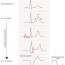 ecg changes due to electrolyte