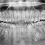 charting supernumerary teeth dentrix