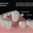 types of dental bridges what type is