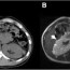 sporadic glomerulocystic kidney disease