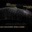 recur corneal erosion syndrome a