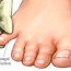 athlete s foot infection family