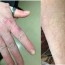 morgellons disease with doxycycline